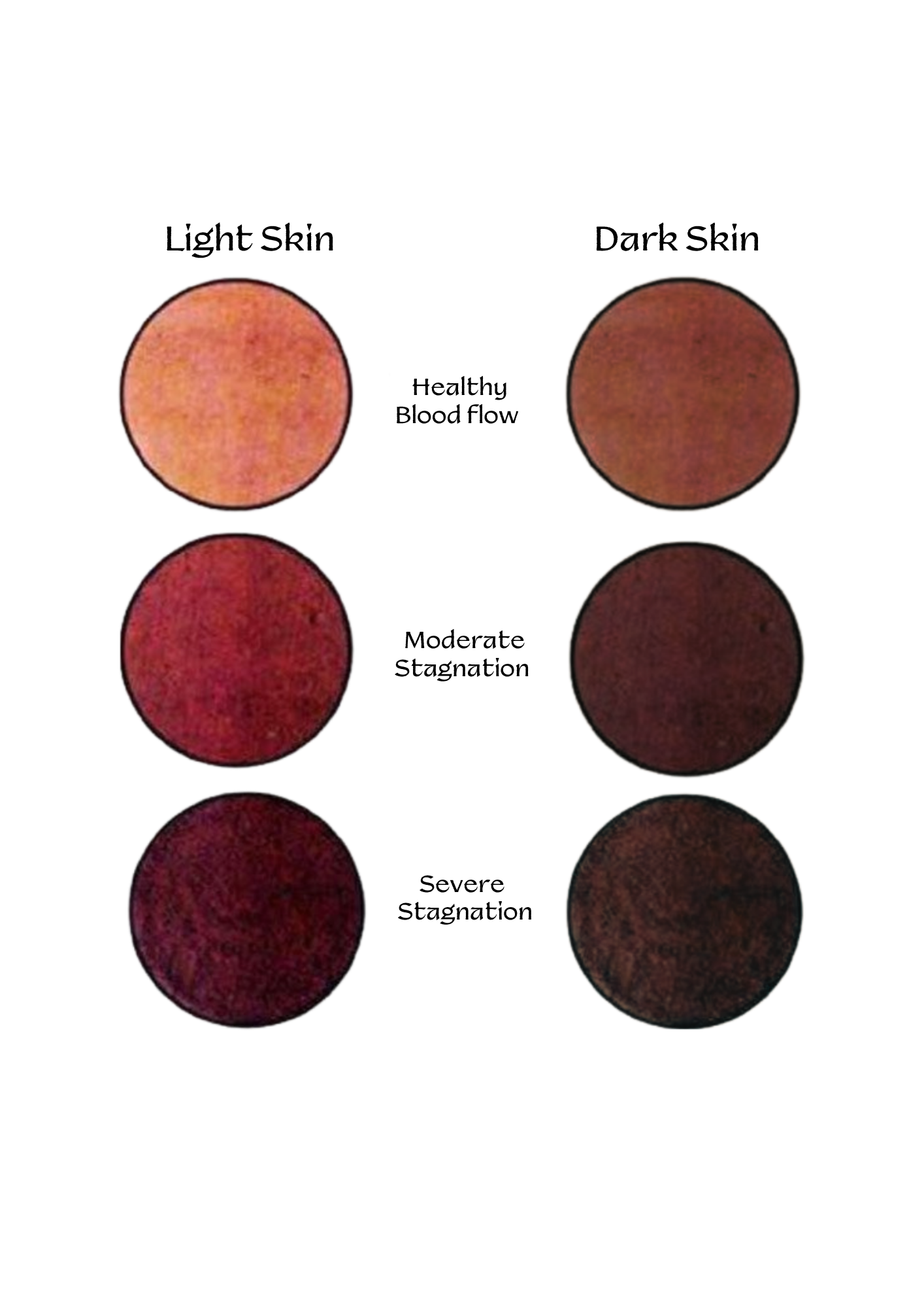 Tableau des couleurs de stagnation sanguine en Hijama — d'une circulation saine à une stagnation sévère